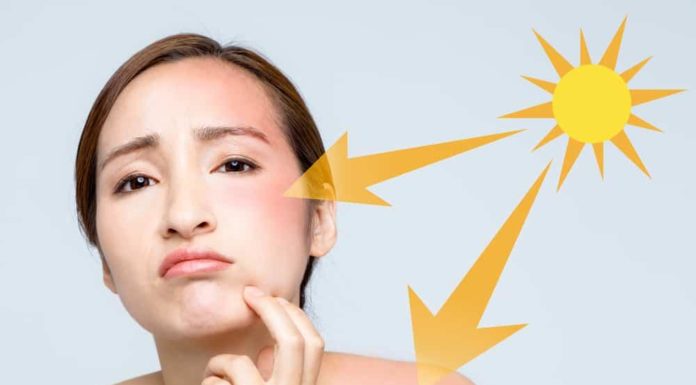 The Sunburn Conundrum: Unveiling the Culprits Behind Skin Discomfort and 4 Potent Remedies for Calming the Irritation