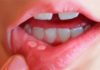 5 Effective Folk Remedies for Curing Mouth Ulcers