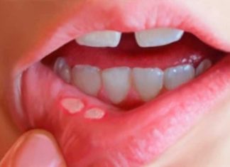 5 Effective Folk Remedies for Curing Mouth Ulcers