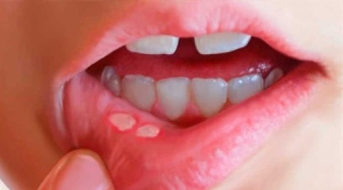 5 Effective Folk Remedies for Curing Mouth Ulcers