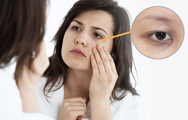 5 Ways to Banish Under Eye Circles and Restore Youthful Skin