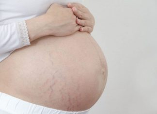 Safe and effective ways to reduce stretch marks during pregnancy