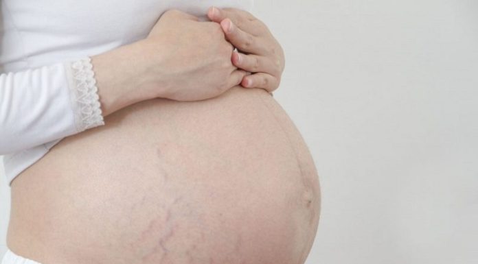 Safe and effective ways to reduce stretch marks during pregnancy