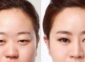 Tips for Optimizing Wound Healing and Preventing Scarring After Eyelid Surgery