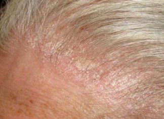 Strategies to Address Dry and Flaky Scalp During Winter