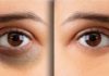 Quick and Effective Ways to Banish Under-Eye Dark Circles in a Blink