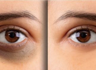 Quick and Effective Ways to Banish Under-Eye Dark Circles in a Blink