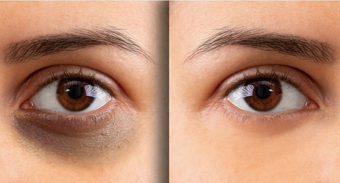 Quick and Effective Ways to Banish Under-Eye Dark Circles in a Blink