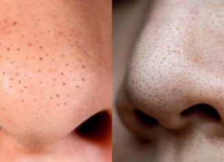 How to Extract Blackheads Without Enlarging Pores