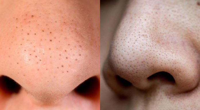How to Extract Blackheads Without Enlarging Pores