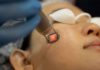 How to effectively treat melasma, freckles, and age spots with laser. Essential tips!