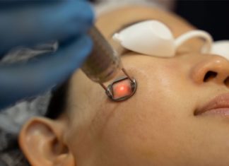 How to effectively treat melasma, freckles, and age spots with laser. Essential tips!