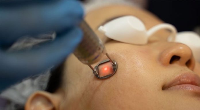How to effectively treat melasma, freckles, and age spots with laser. Essential tips!