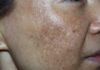New Approach to Fading Hyperpigmentation with Pumpkin Seed Oil Blend