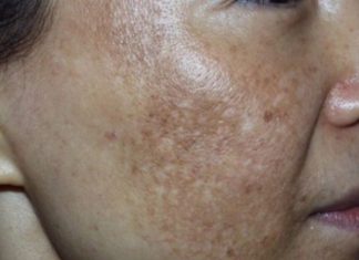 New Approach to Fading Hyperpigmentation with Pumpkin Seed Oil Blend