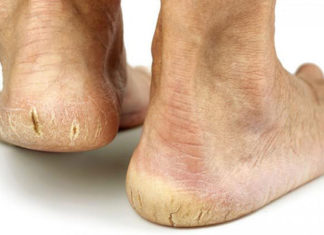 Revel in the Wonders of Lemon for Cracked Heels