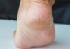 Essential Home Remedies for Cracked Heels: Don’t Miss Out!