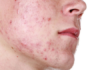 Pocket-Friendly, Effective, and Safe Home Remedies for Treating Cystic Acne