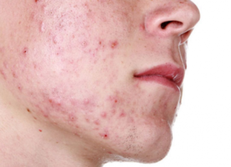 Pocket-Friendly, Effective, and Safe Home Remedies for Treating Cystic Acne