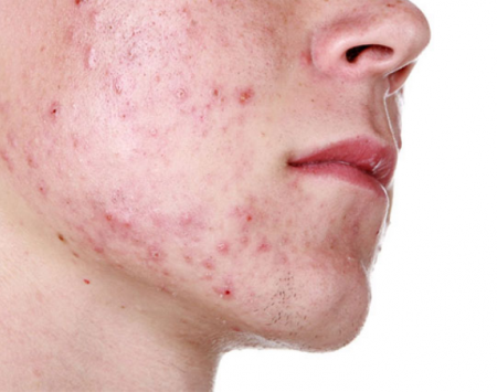 Pocket-Friendly, Effective, and Safe Home Remedies for Treating Cystic Acne