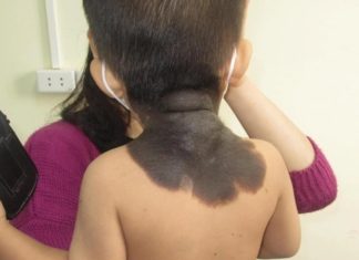 Want your baby to be born without blemishes, ugly eczema, pregnant mothers just need to do one thing