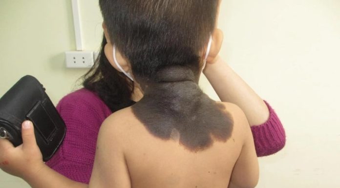 Want your baby to be born without blemishes, ugly eczema, pregnant mothers just need to do one thing