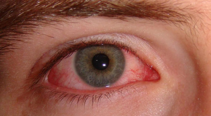 Choosing the Right Sunglasses for Red Eyes: Understanding the Benefits