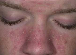 Getting Rid of Dry, Peeling Skin on your Nose Fast