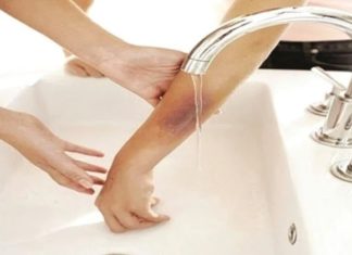 Simple and Effective Home Remedies for Burns You Should Know