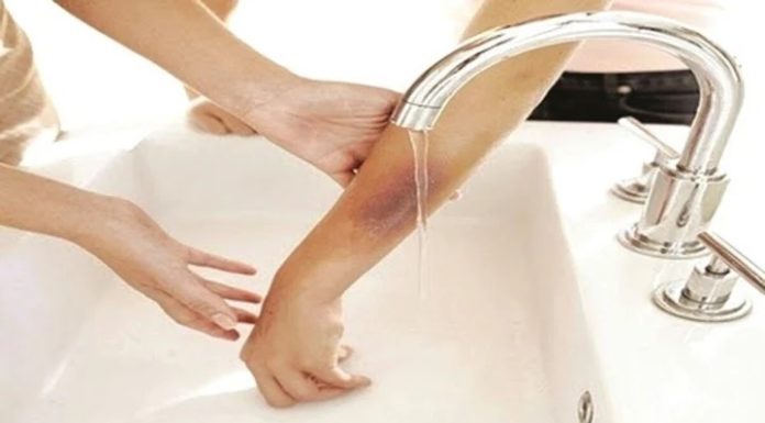 Simple and Effective Home Remedies for Burns You Should Know