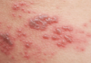 Simple home remedies to treat shingles for high effectiveness that few people know