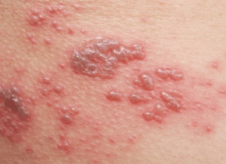Simple home remedies to treat shingles for high effectiveness that few people know