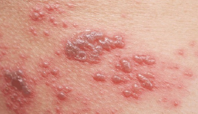 Simple home remedies to treat shingles for high effectiveness that few people know