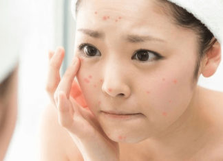 Habits of your hands that make your skin prone to acne