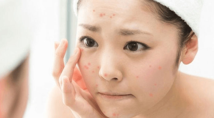 Habits of your hands that make your skin prone to acne