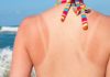 Sunburn Severity Levels and Safe Recovery Time for Your Skin to Know
