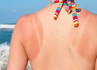 Sunburn Severity Levels and Safe Recovery Time for Your Skin to Know