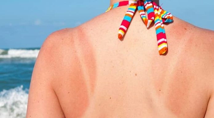 Sunburn Severity Levels and Safe Recovery Time for Your Skin to Know