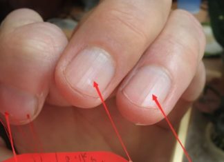3 Nail Health Signs You Shouldn’t Ignore, Get Checked Now to Avoid Regret
