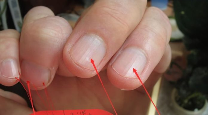 3 Nail Health Signs You Shouldn’t Ignore, Get Checked Now to Avoid Regret