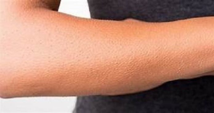 Unraveling the Goosebumps Enigma: Boon or Bane?