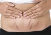 Tips to fade postpartum stretch marks and achieve smooth and firm skin