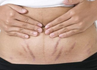 Tips to fade postpartum stretch marks and achieve smooth and firm skin
