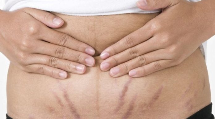 Tips to fade postpartum stretch marks and achieve smooth and firm skin