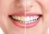 4 Simple Tips to Get Rid of Yellow Stained Teeth