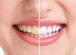 4 Simple Tips to Get Rid of Yellow Stained Teeth