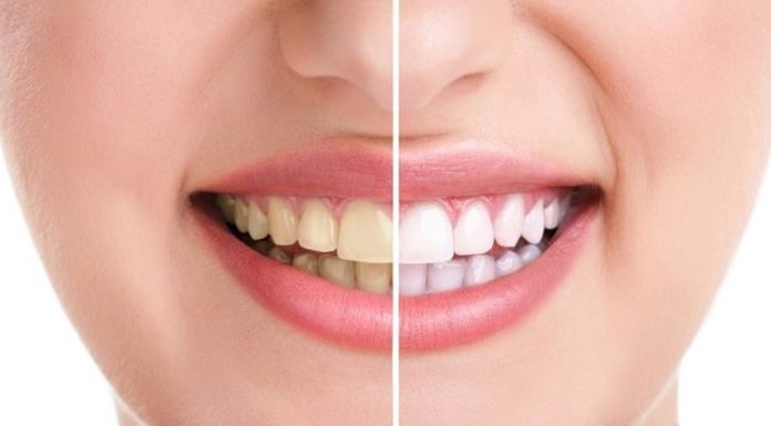 4 Simple Tips to Get Rid of Yellow Stained Teeth