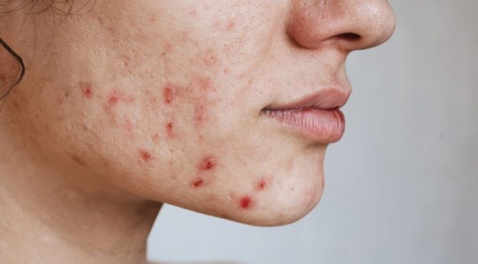 Does eating instant noodles cause acne? How to eat instant noodles without getting pimples?