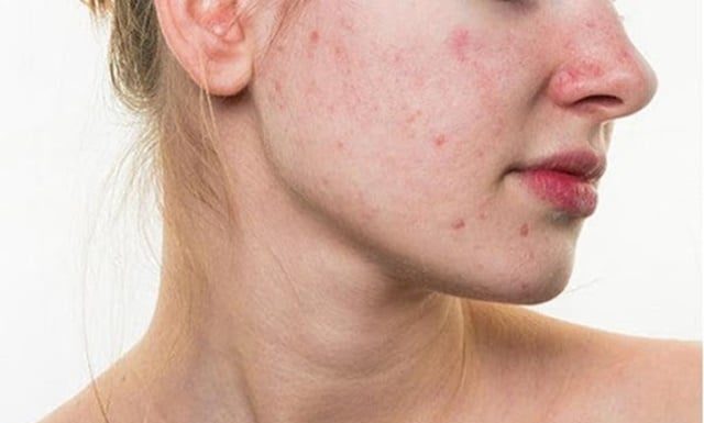 What Does Cleansing Oil Do? Can It Be Used on Acne-Prone Skin?