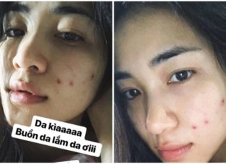 Hoang Ha Minzy’s Purslane Therapy: A Revolutionary Approach to Acne and Skin Rejuvenation